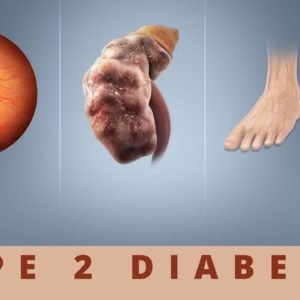 Type 2 Diabetes (High Blood Sugar)